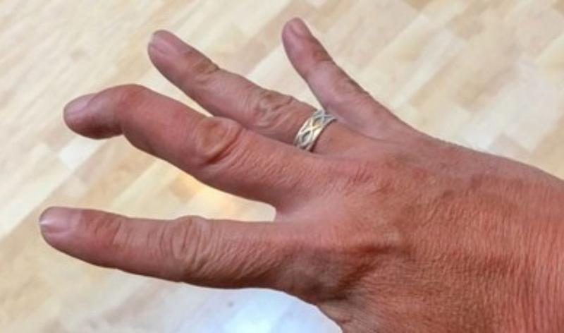 Tendon & Ligament Tears